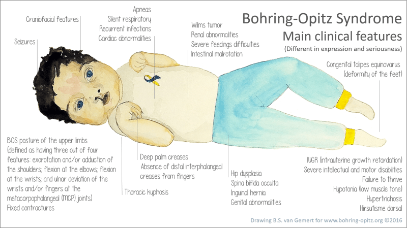 clinical features Bohring-Opitz Syndrome